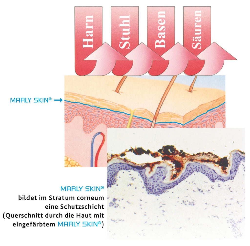 Inkontinenz Assoziierte Dermatitis Marly Skin inkontinenz-assoziierte-dermatitis-marly-skin