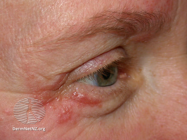 Periorale Dermatitis Marly Skin